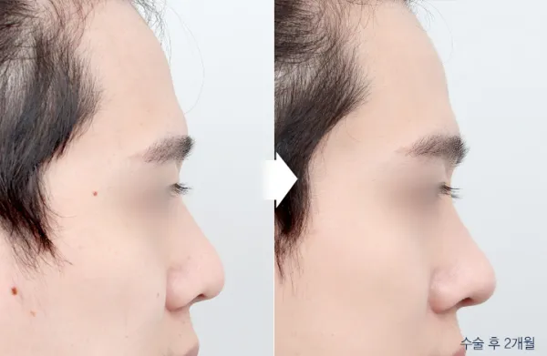 Before/After
