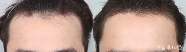 Before/After