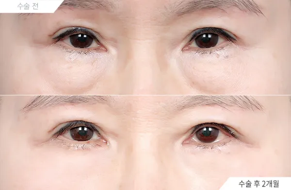Before/After