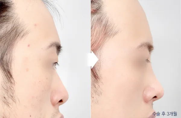 Before/After