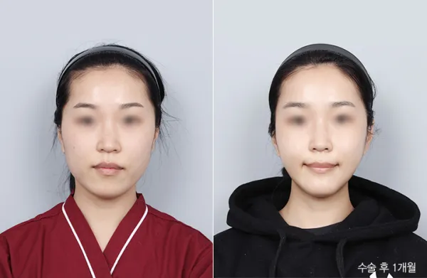 Before/After