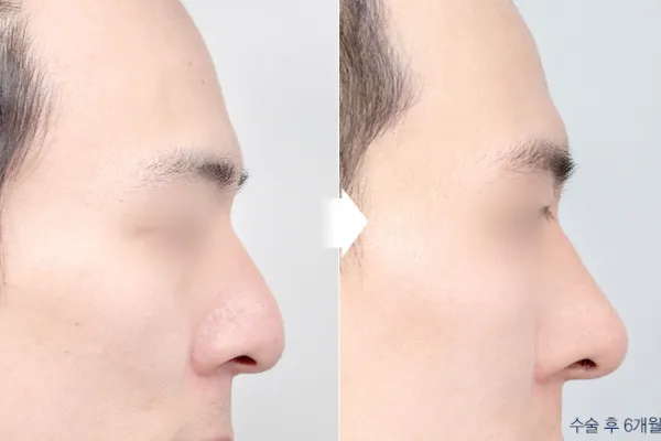 Before/After