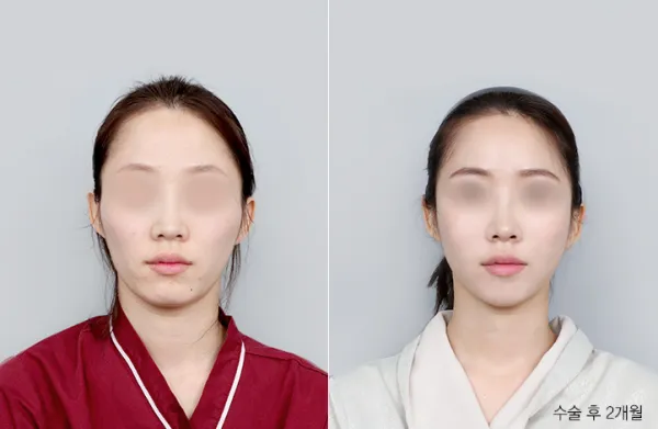 Before/After