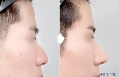 Before & After