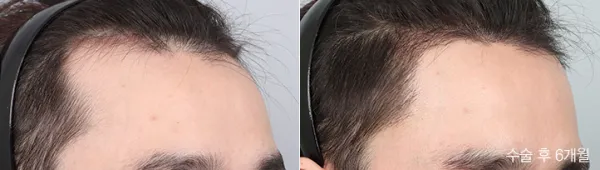 Before/After