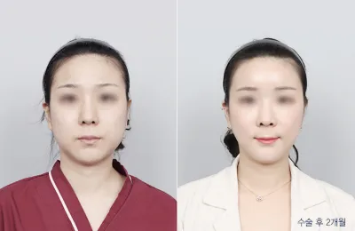 Before & After