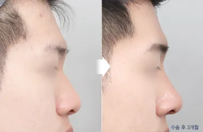 Before & After