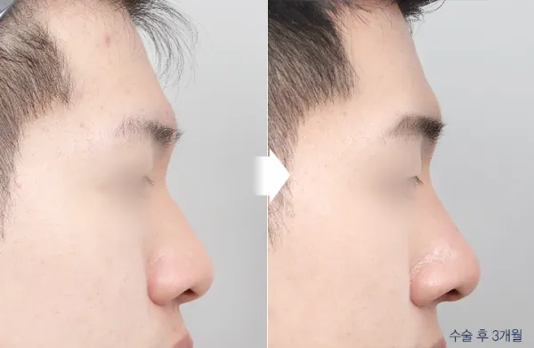 Before/After