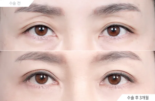 Before/After