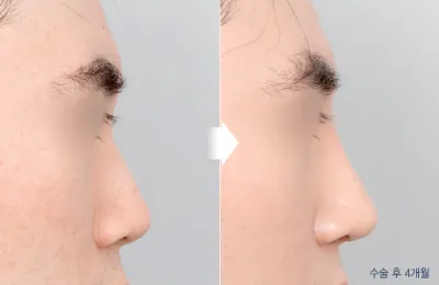 Before & After