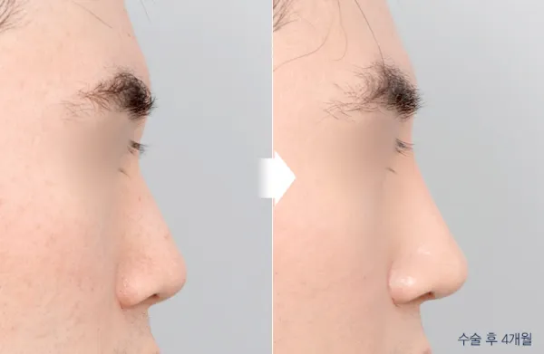 Before/After
