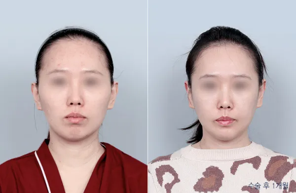 Before/After