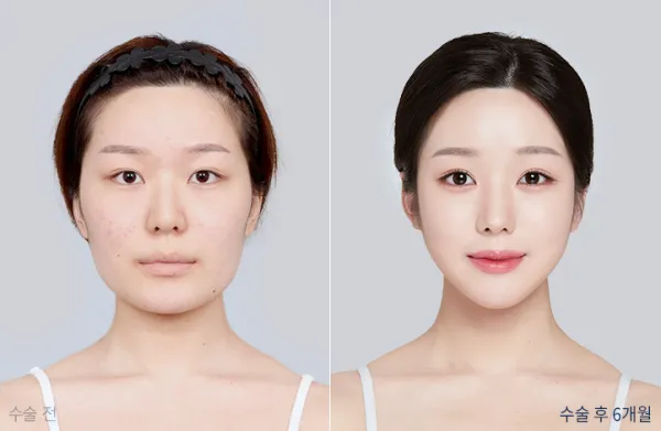 Before/After