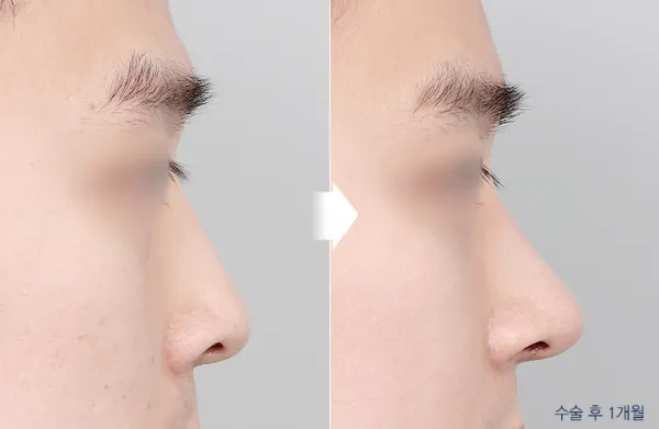 Before/After