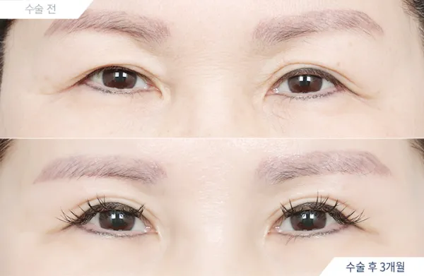 Before/After