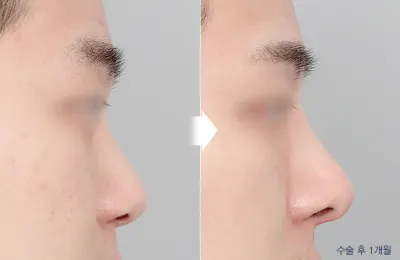 Before & After