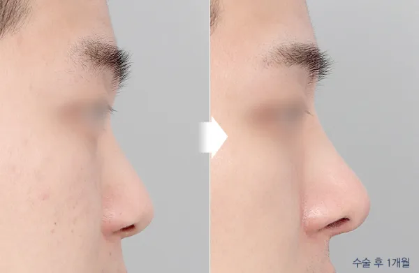Before/After
