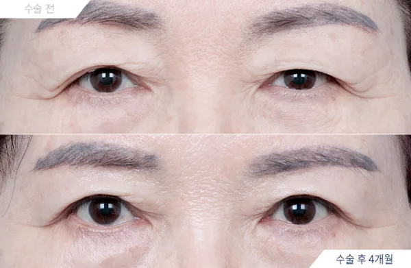 Before/After