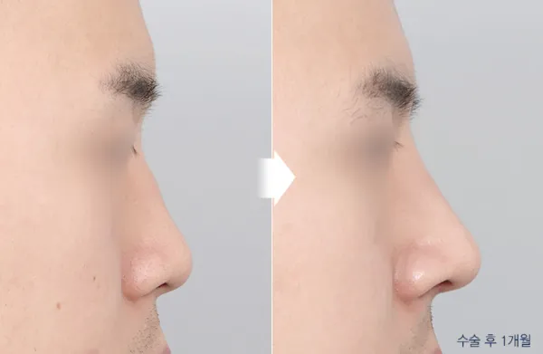Before/After