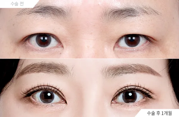 Before/After