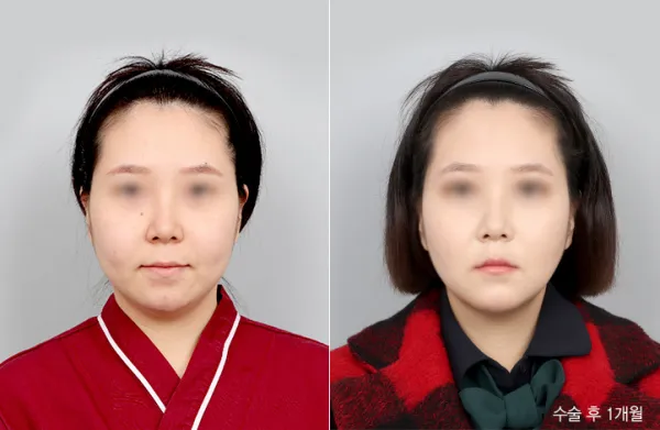 Before/After