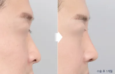 Before & After