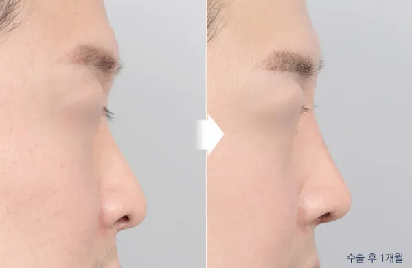 Before/After