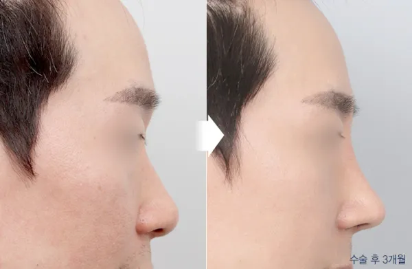 Before/After