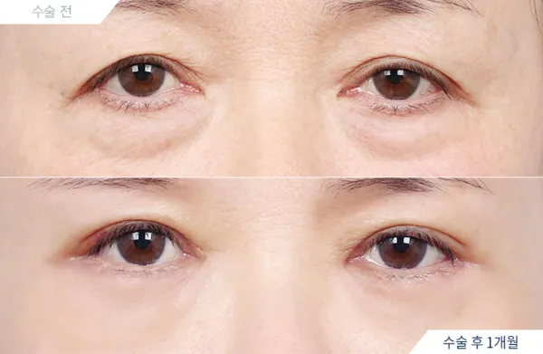 Before/After