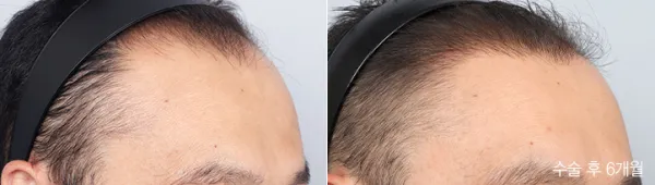 Before/After