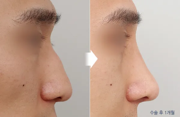 Before/After