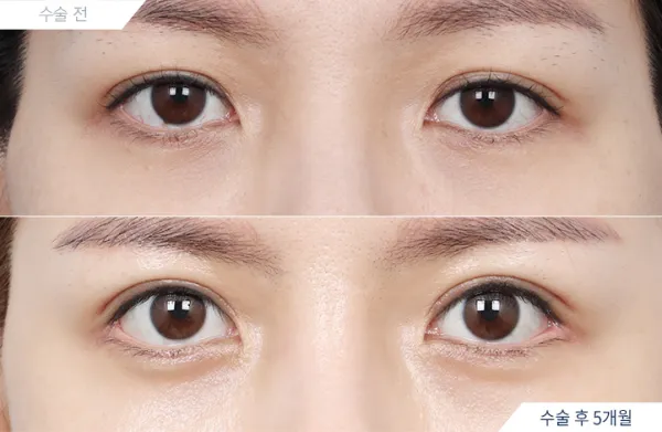 Before/After