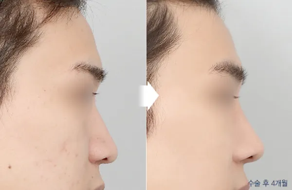 Before/After