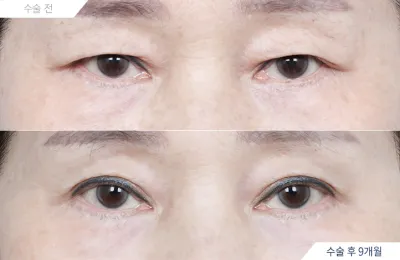 Before & After
