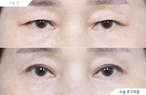 Before/After