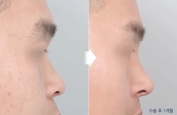 Before/After