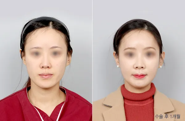 Before/After