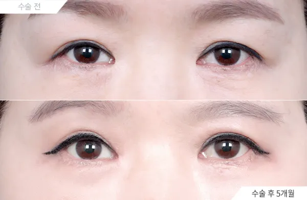 Before/After
