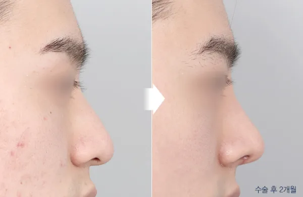 Before/After