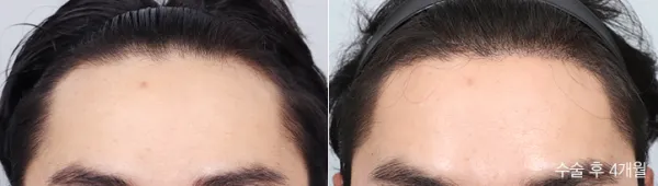 Before/After