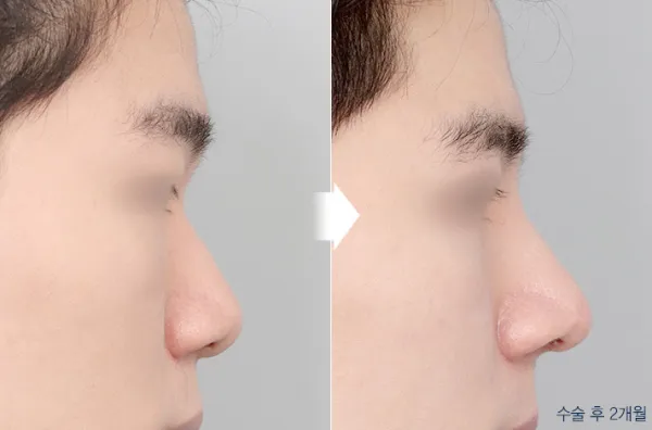 Before/After