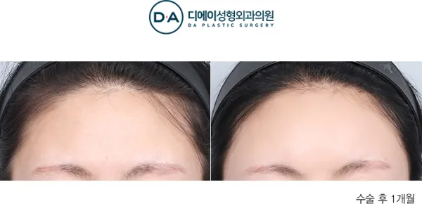 Before/After