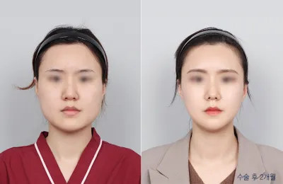Before & After