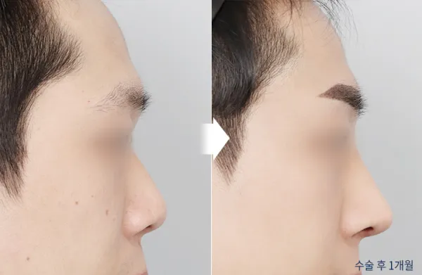 Before/After