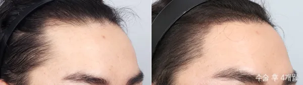 Before/After