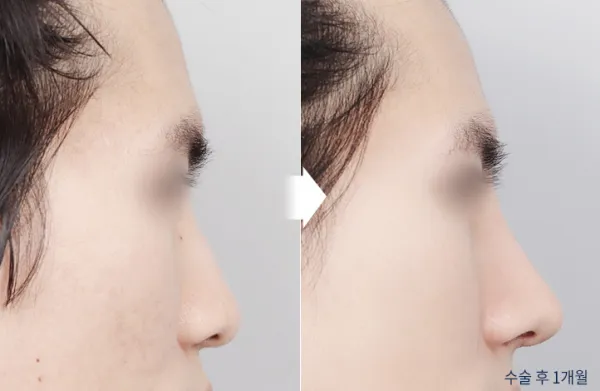 Before/After