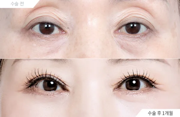 Before/After