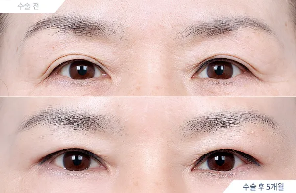 Before/After
