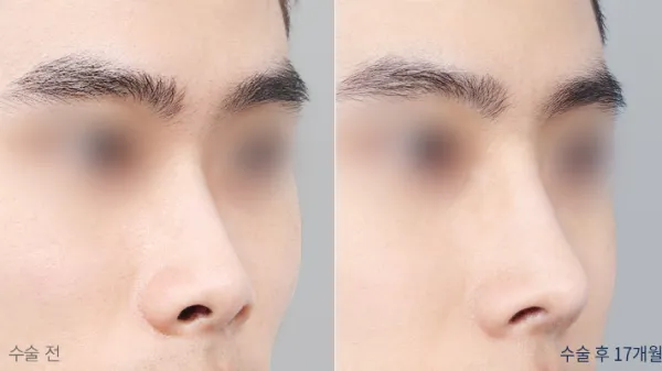 Before/After
