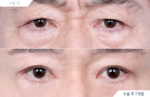 Before/After